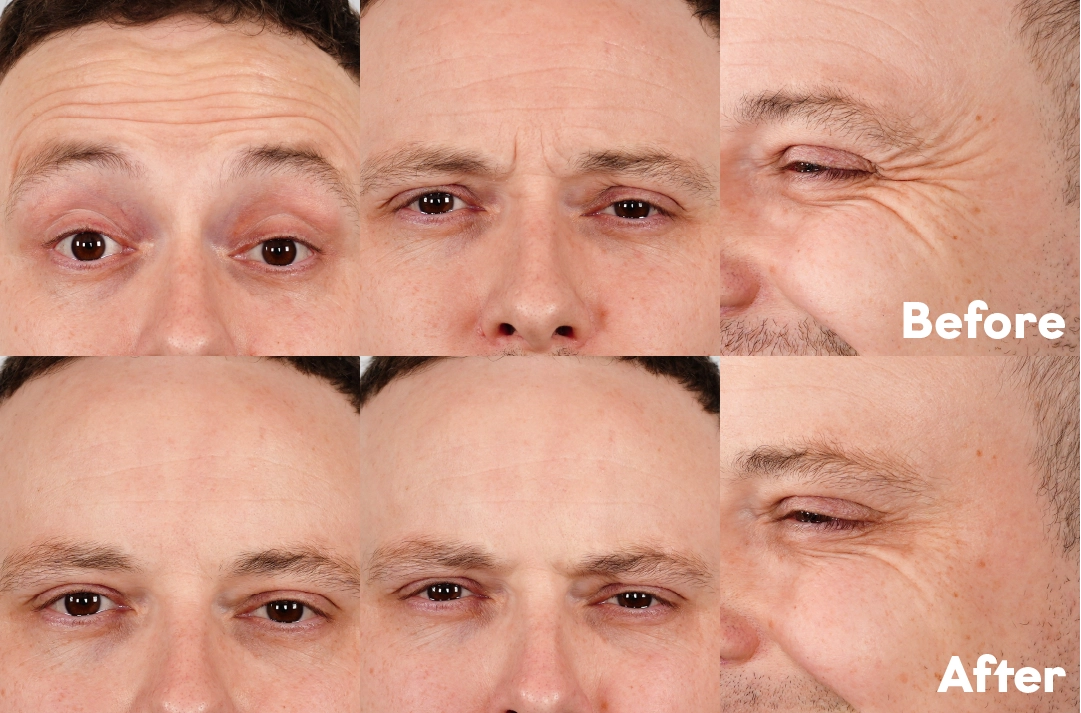 Before and after Anti-Wrinkle Treatment for Men result