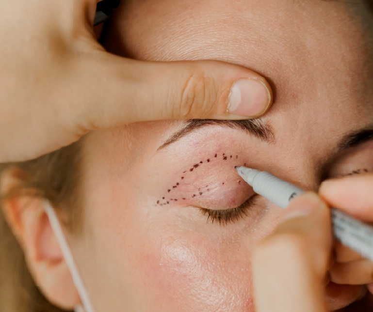 Upper Eyelid Blepharoplasty at Sisu Clinic