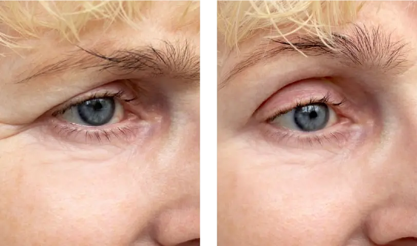 Blepharoplasty Before & After