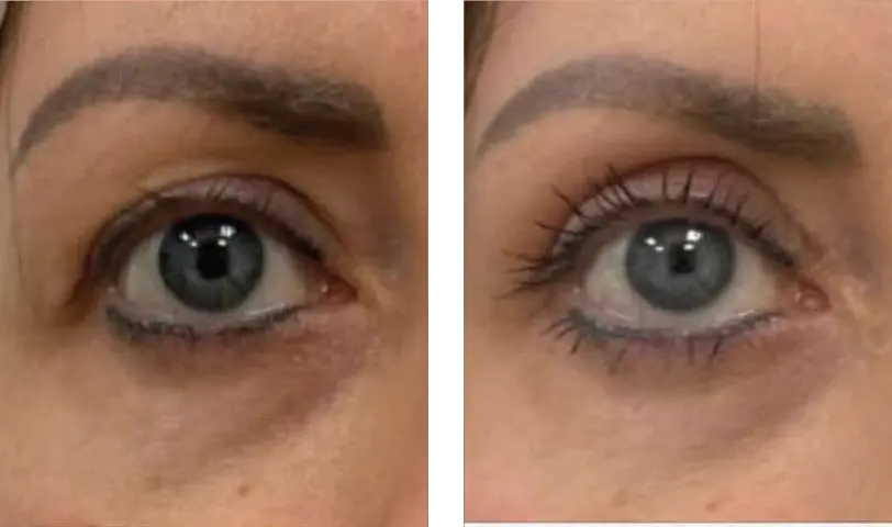 Blepharoplasty Before & After