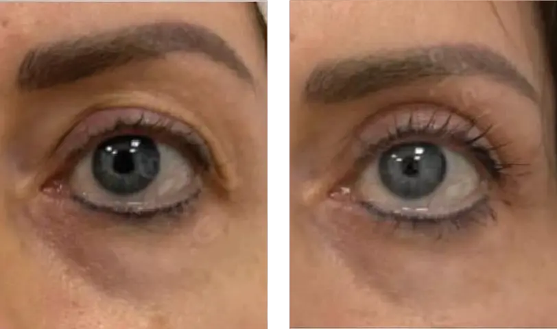 Blepharoplasty Before & After
