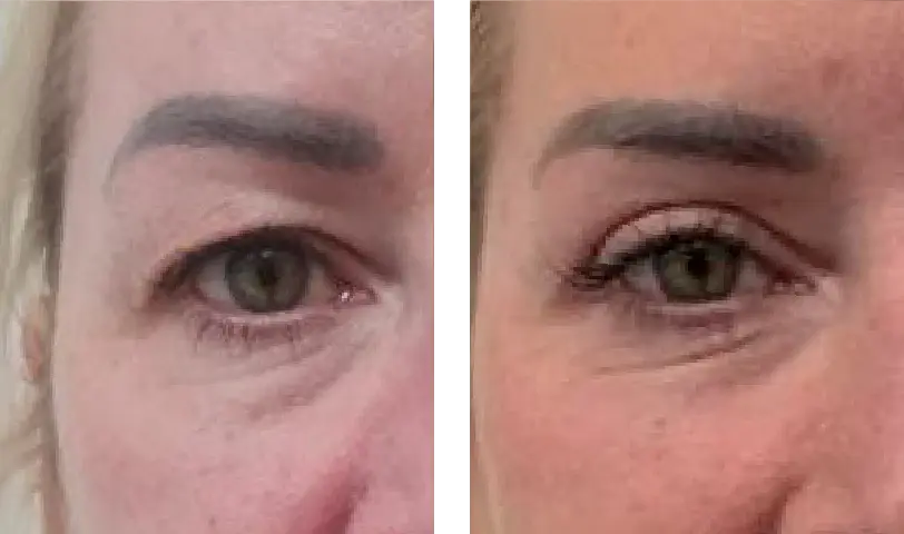 Blepharoplasty Before & After