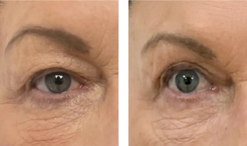 Blepharoplasty Before & After