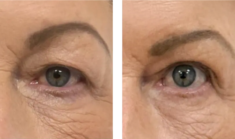 Blepharoplasty Before & After