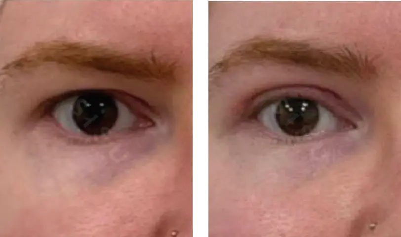 Blepharoplasty Before & After