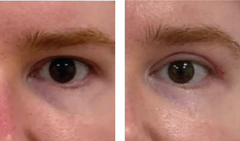 Blepharoplasty Before & After