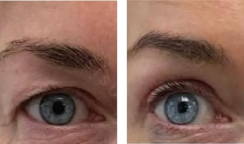 Blepharoplasty Before & After