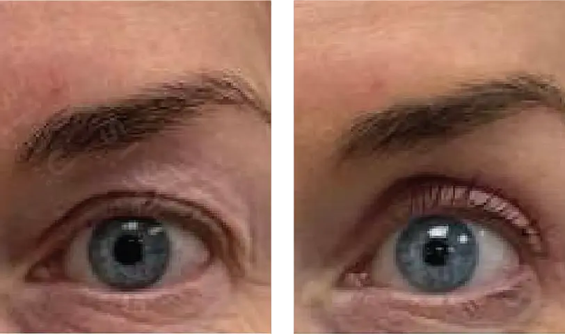 Blepharoplasty Before & After