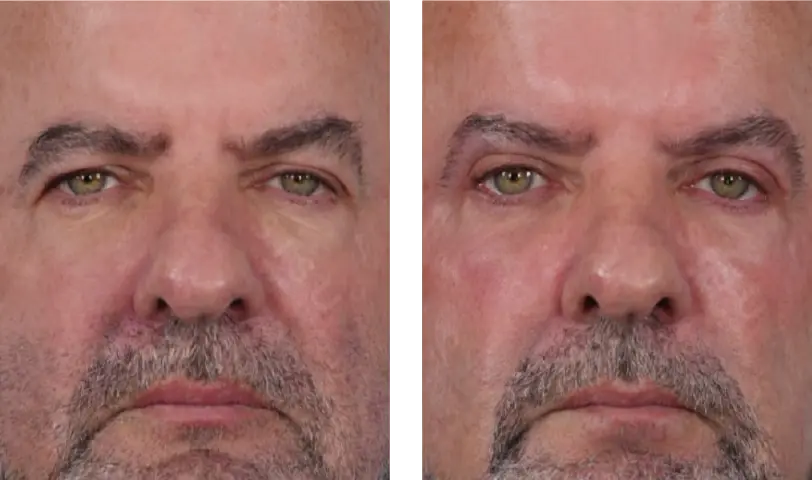 Blepharoplasty Before & After