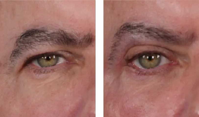 Blepharoplasty Before & After