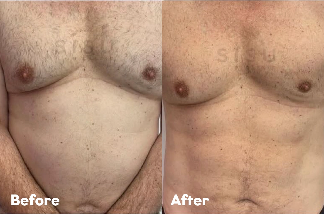Before and after Body Fat Reduction Treatment result