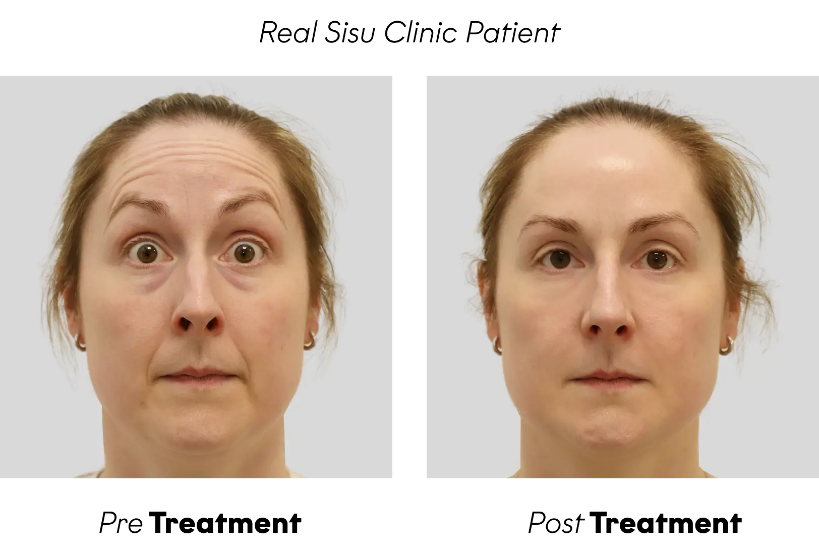 Before and after Bridal Package result