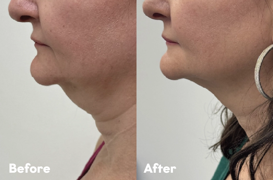 Before and after Chin Fat Reduction Treatment result