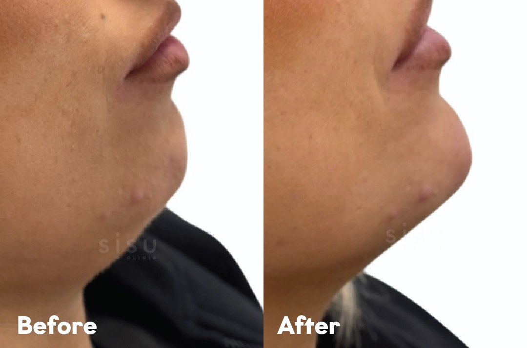Before and after Chin Filler Treatment result