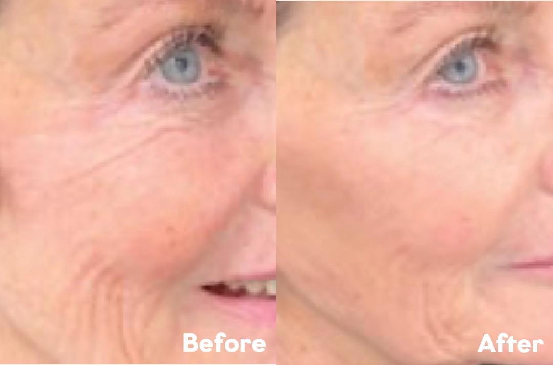 Before and after Collagen Filaments result