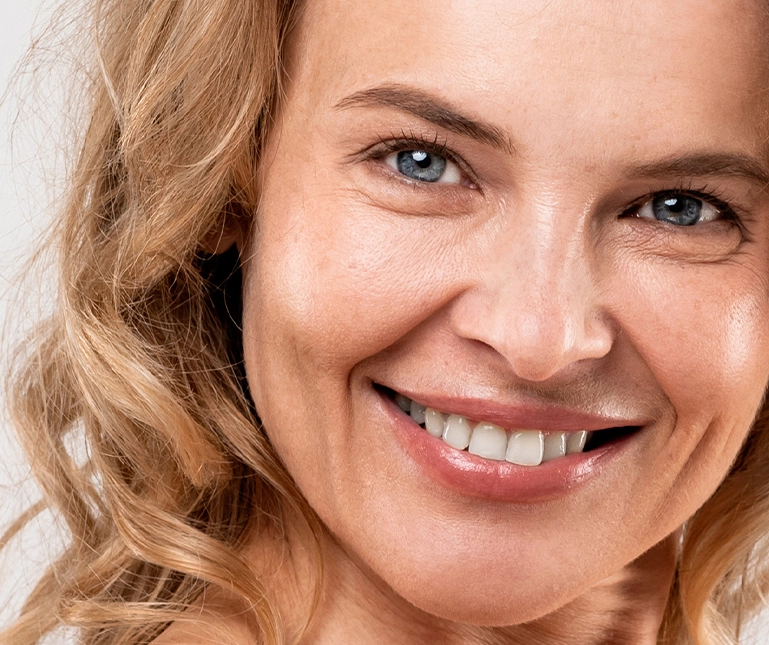 Collagen Filaments patient with lifted cheekbones