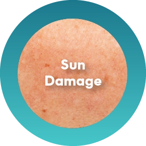 Sun Damage