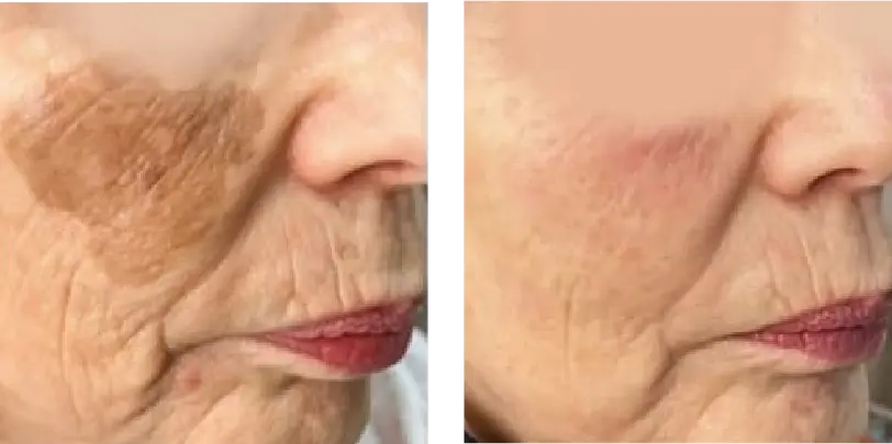 Hyperpigmentation Before & After