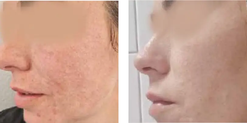 Acne & Rosacea Before & After