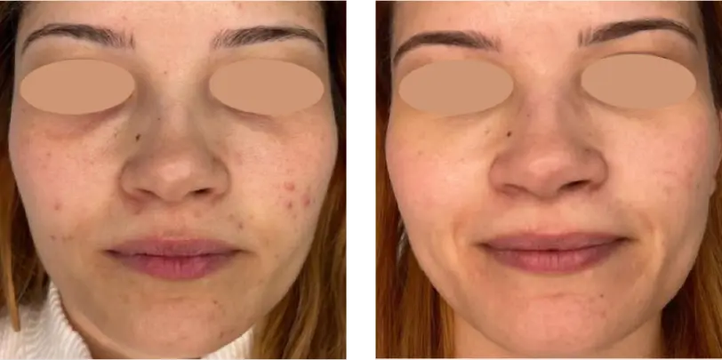 Hyperpigmentation Before & After
