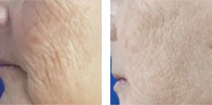 Wrinkles & Skin Texture Before & After