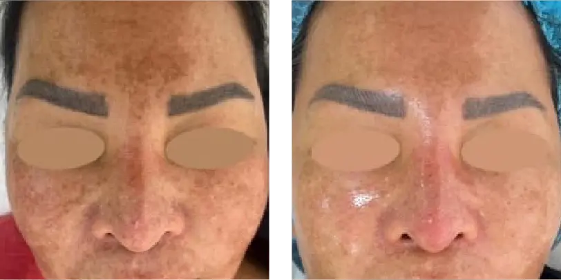 Reduce Pigmentation Before & After