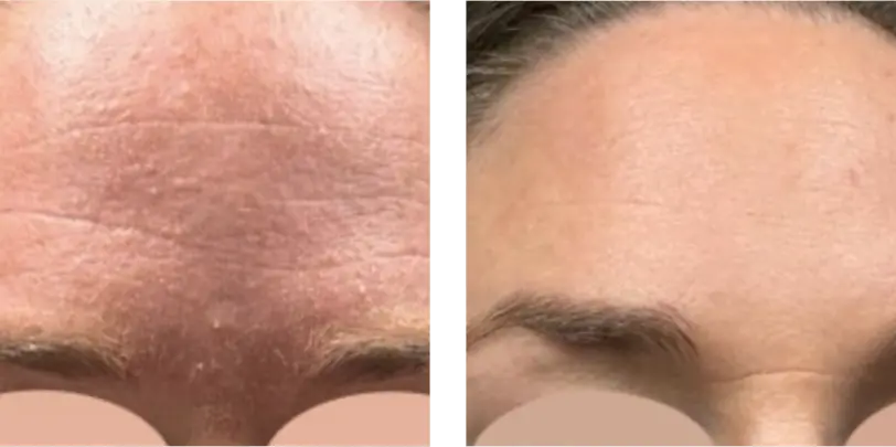 Improved Complexion Before & After