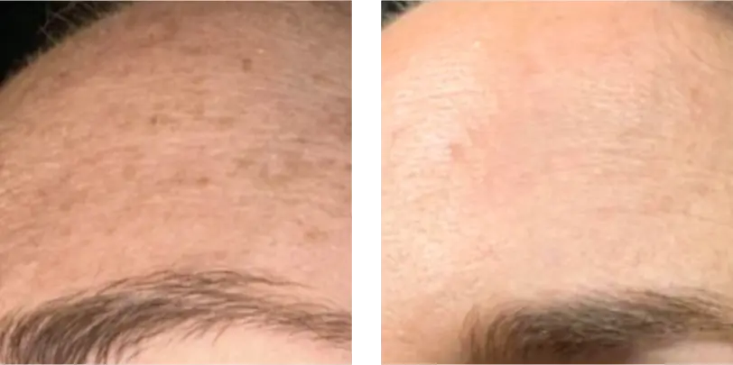 Reduce Pigmentation Before & After