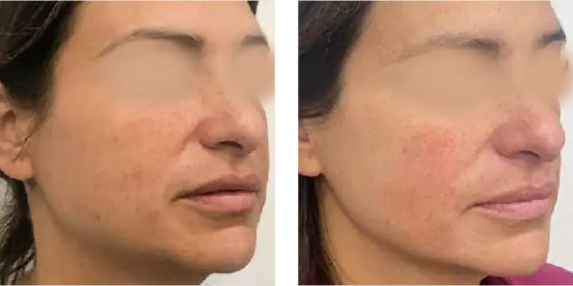 Dehydrated Skin Before & After