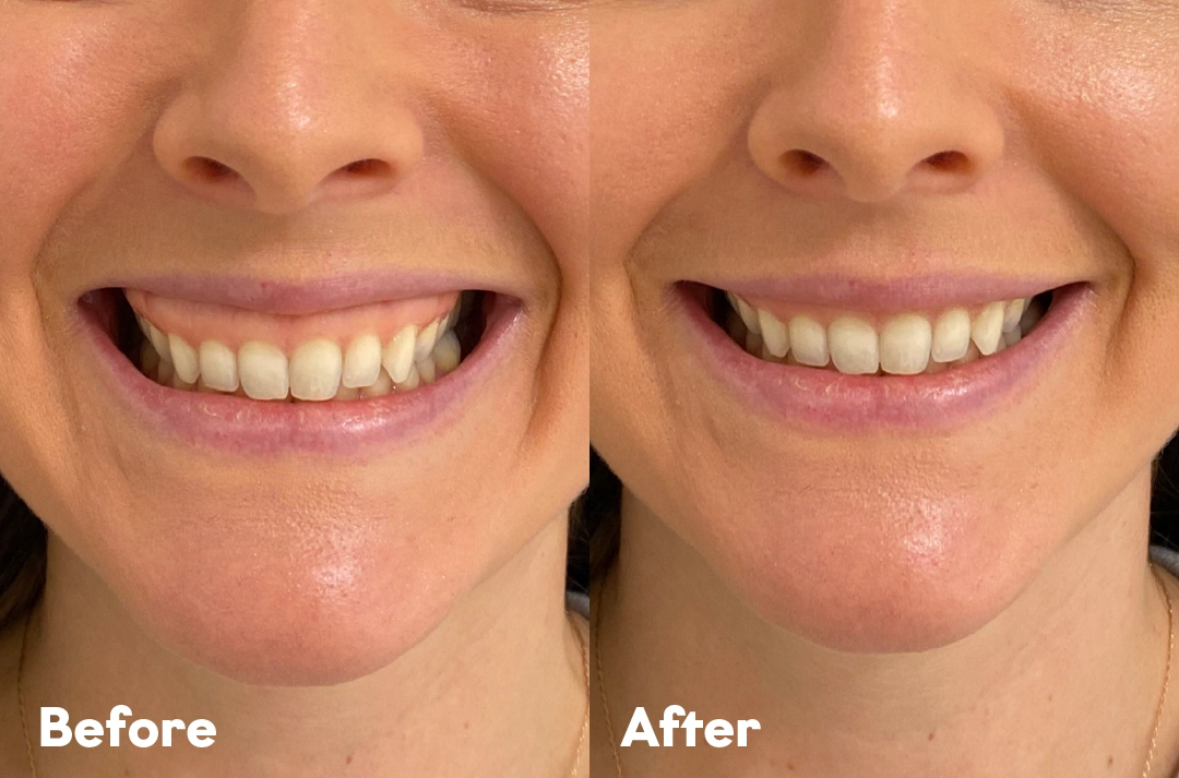 Before and after Gummy Smile Treatment result