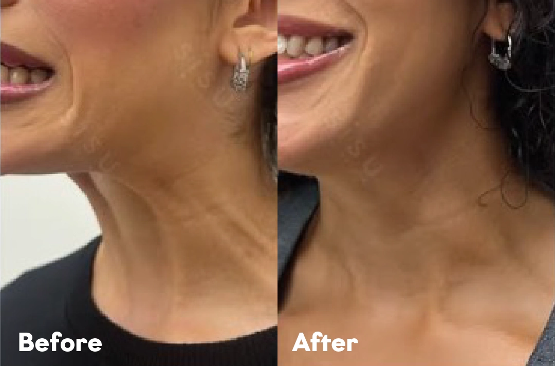 Before and after Neck Lift Treatment result
