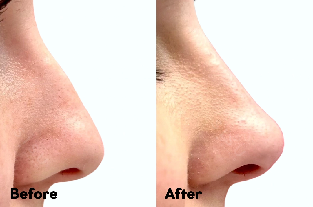 Before and after Non-Surgical Rhinoplasty Treatment result