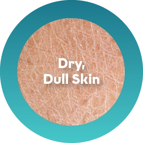 Dry or Dehydrated Body Skin