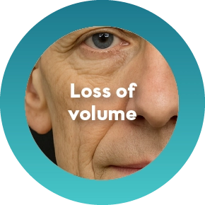 Loss of volume