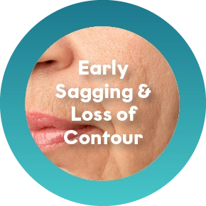 Midface or Cheek Softening