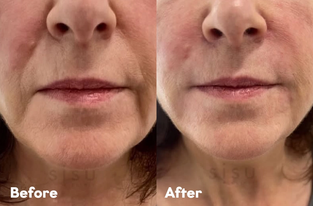 Before and after Sisu Platinum result