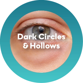 Under-eye hollows