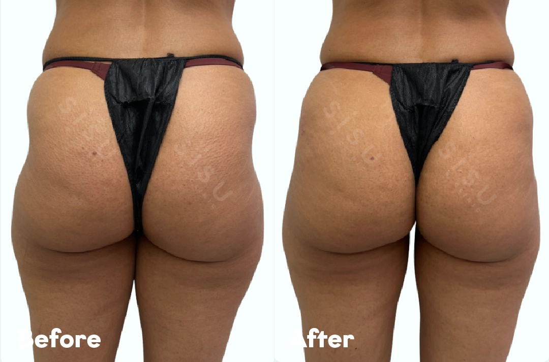 Before and after Sculptra® Bum Lift Treatment result