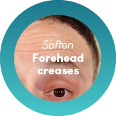 Crow’s Feet Around the Eyes