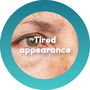 Upper Eyelid Hooding