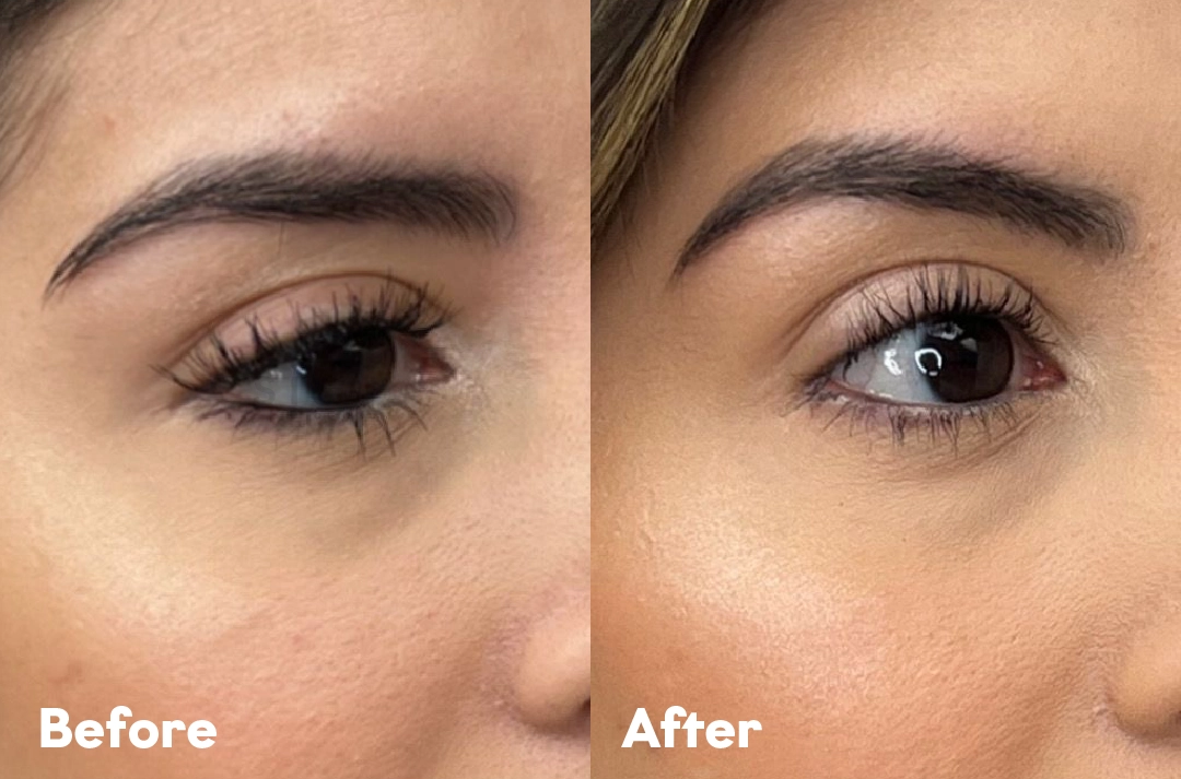 Before and after Botox Brow Lift Treatment result