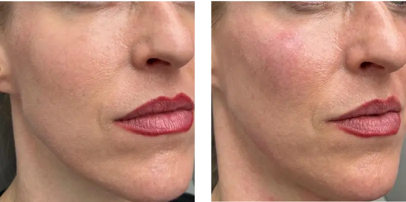 Before and after Cheek Filler Treatment result
