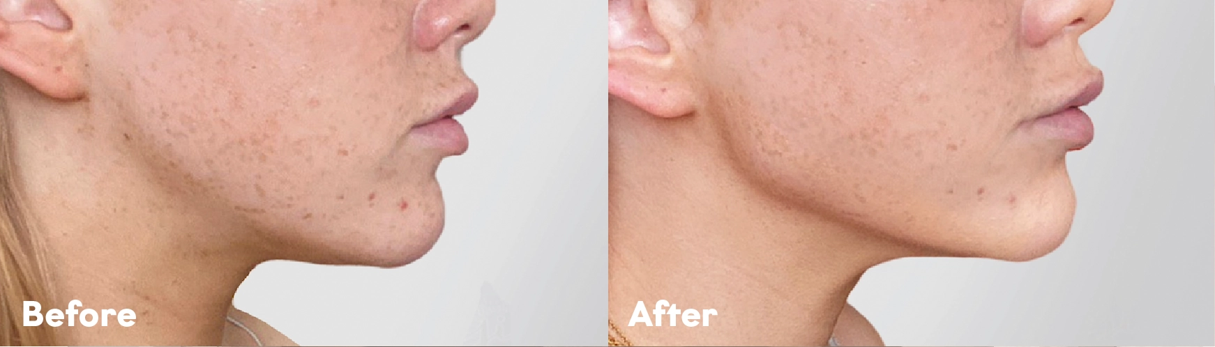 Before and after Jawline Filler Treatment result