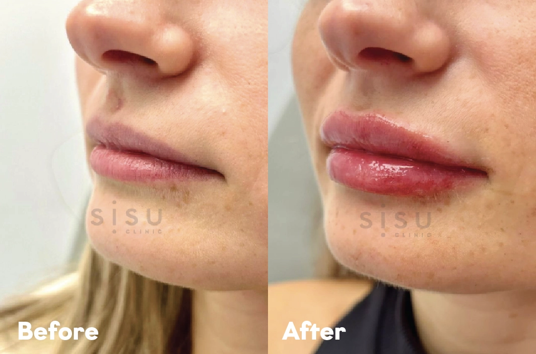 Before and after Lip Filler Treatment result