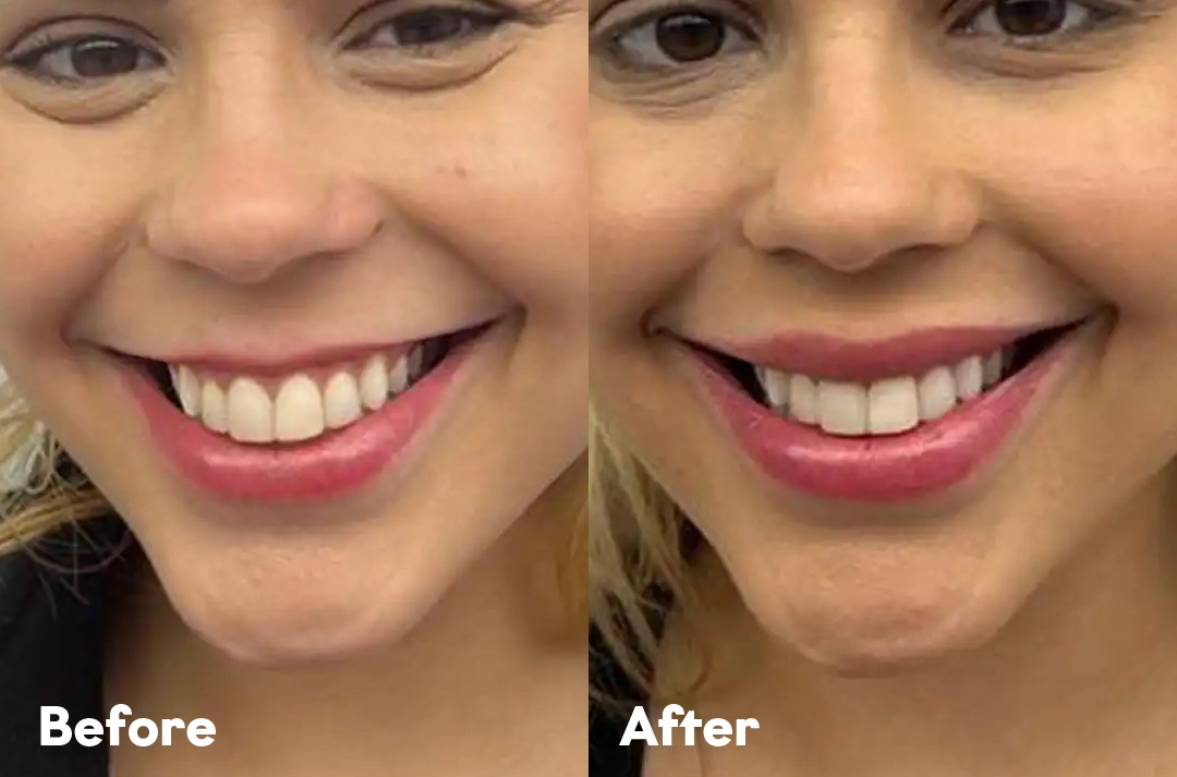 Before and after Lip Flip Treatment result