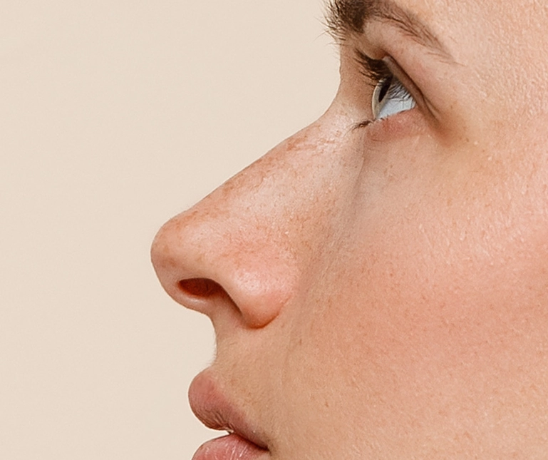 Non-Surgical Rhinoplasty Liquid Nose Job
