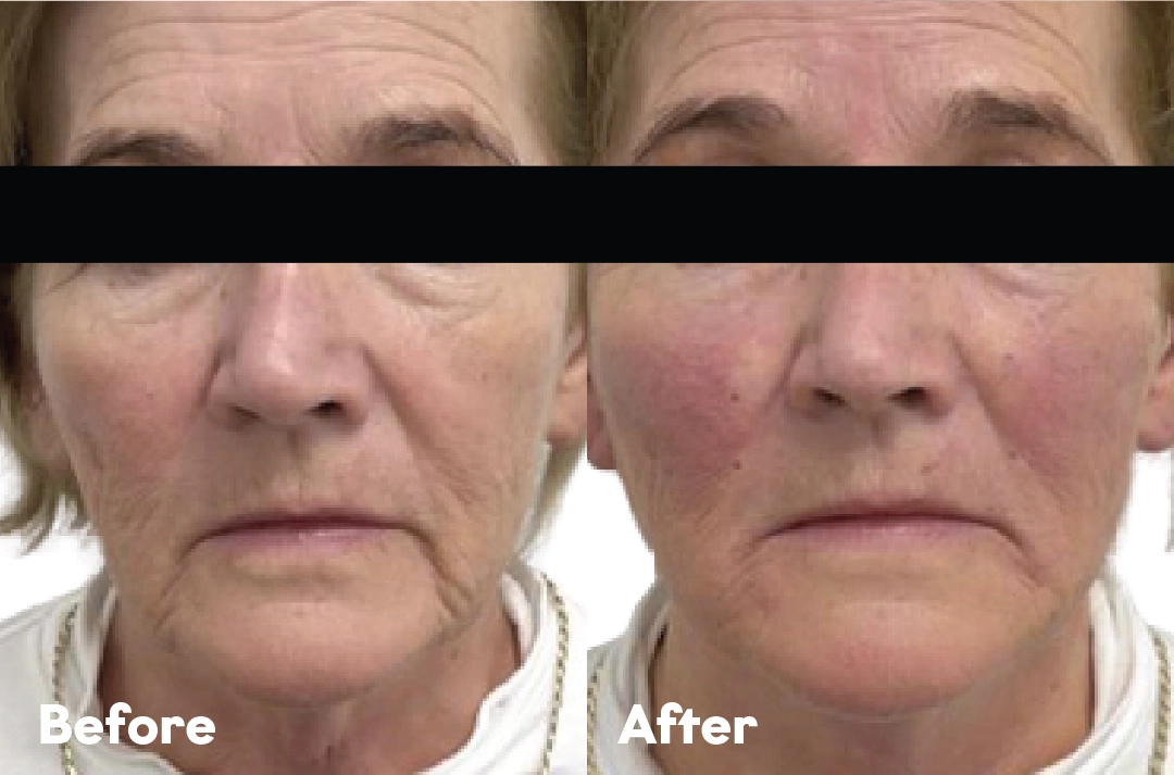 Before and after PDO Thread Lift Treatment result