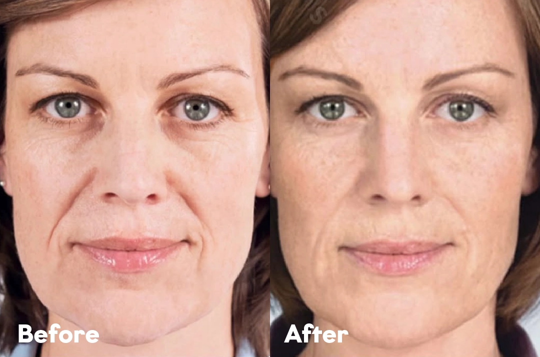 Before and after Sculptra® Treatment result