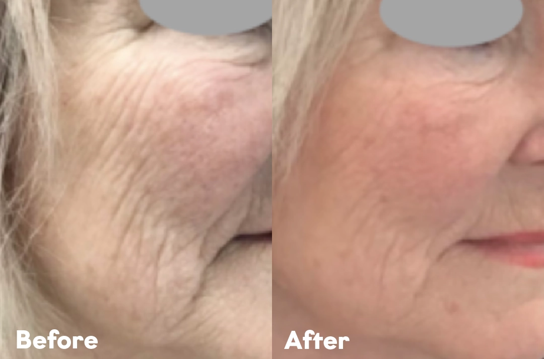 Before and after Sisu Revitalize result