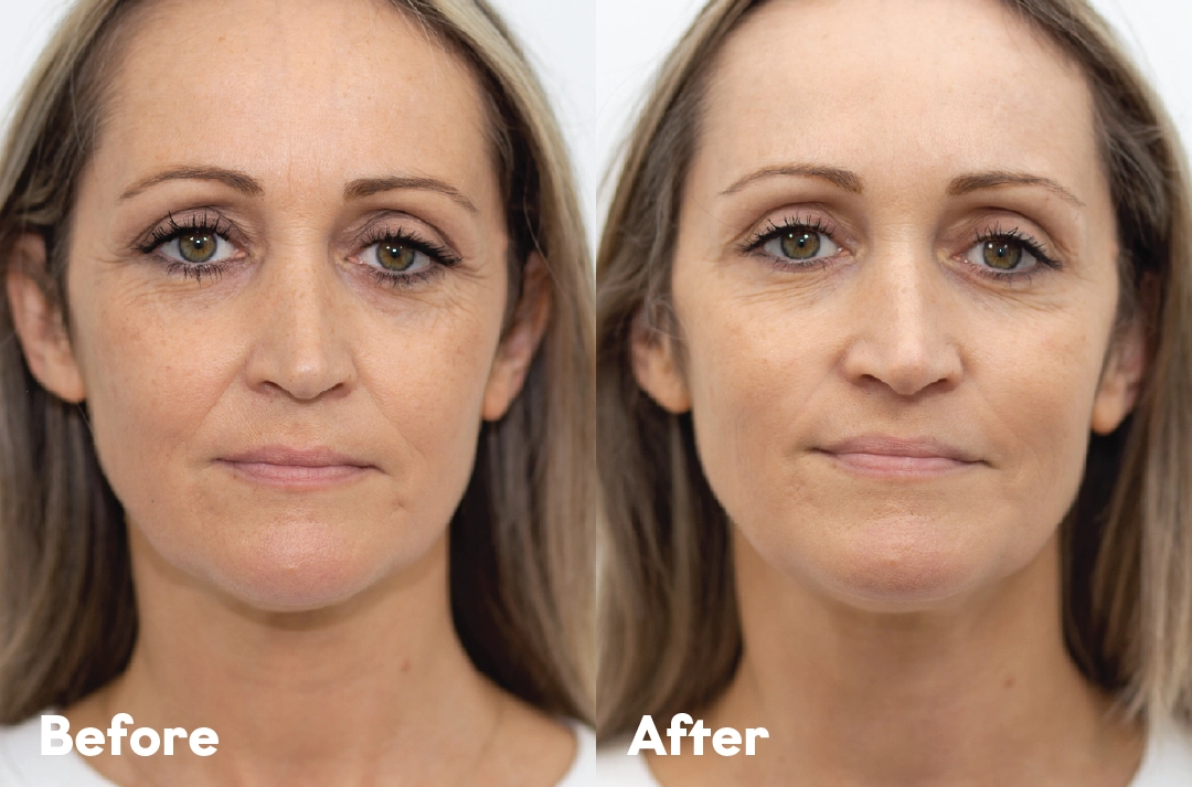 Before and after SkinVive® Treatment result